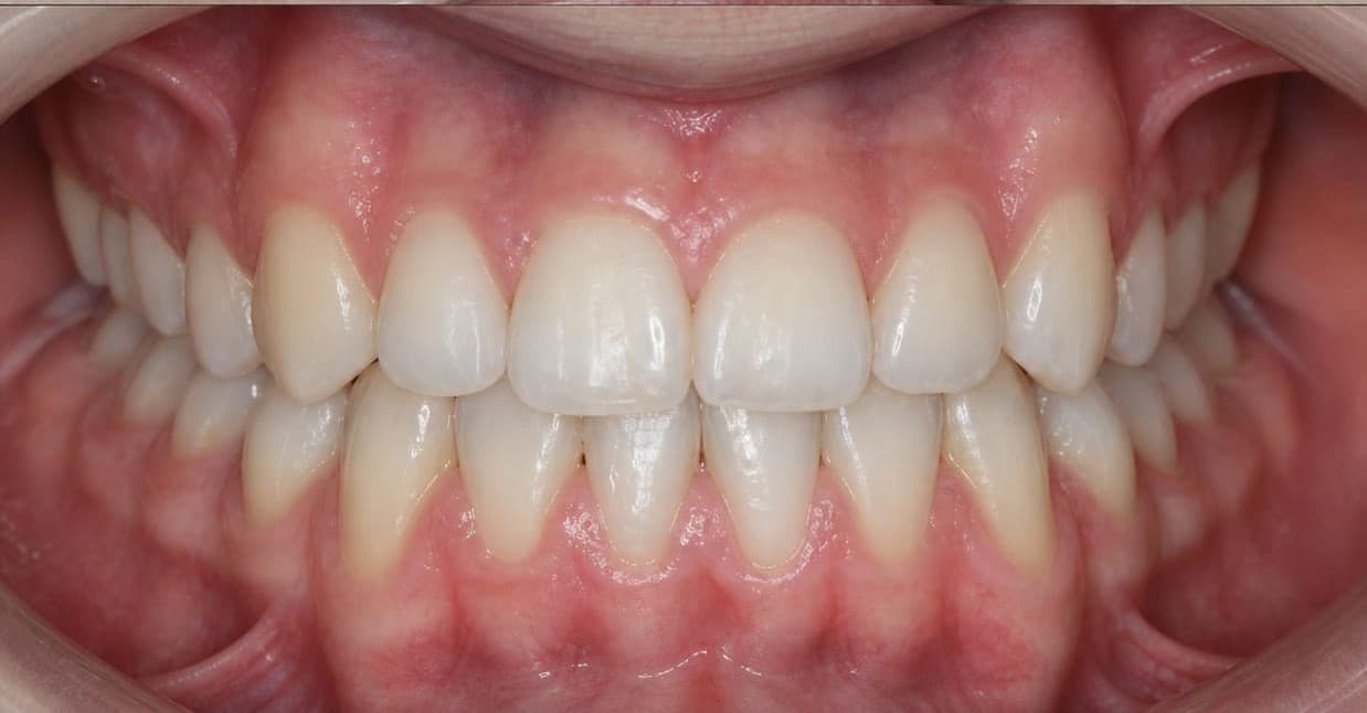 Clear aligner case 2 — after treatment, alignment corrected
