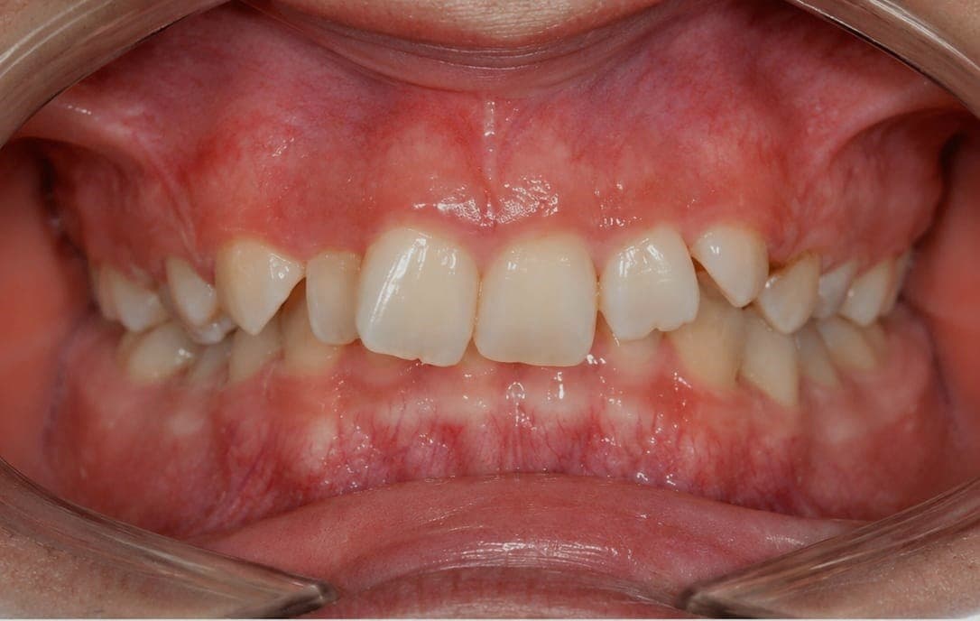 Clear aligner case 1 — before treatment, crowding visible