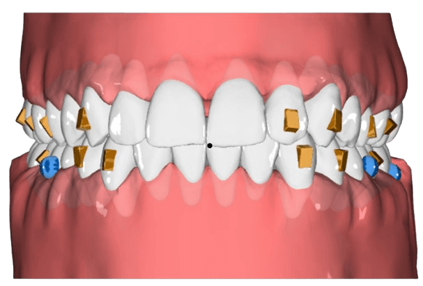 Crossbite — final tooth positions