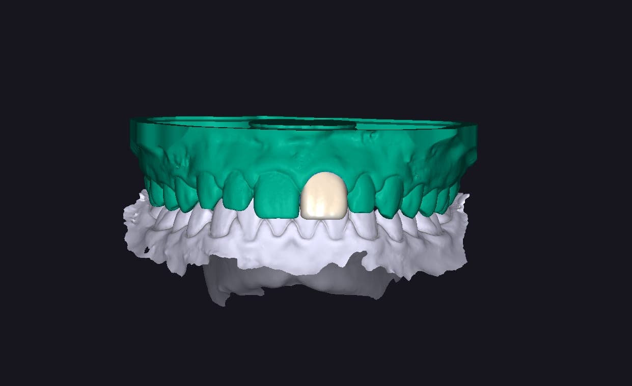 Dental CAD Design (exocad & 3Shape)