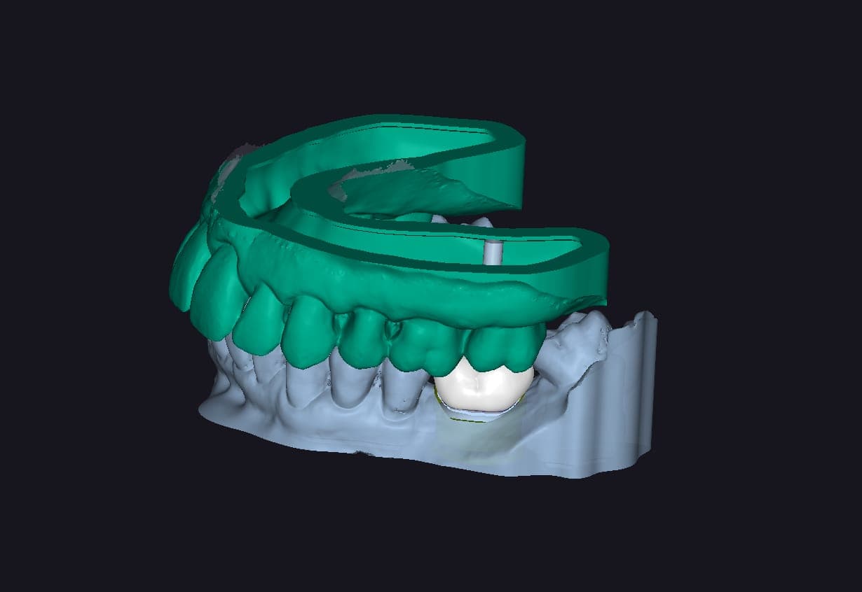 Implant Crown Design