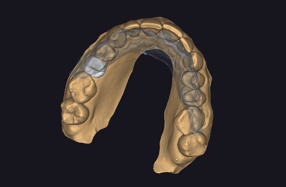 Posterior crown CAD design in progress